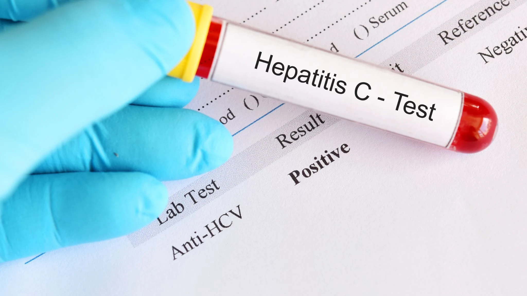 Hepatitis C